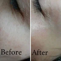 فشیال پوست رفع لک در مطب زیبایی .بانوان -اقایان|خدمات آرایشگری و زیبایی|شیراز, رازی|دیوار