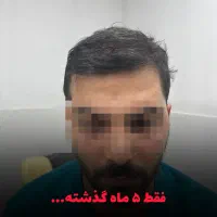 کاشت ابرو و مو با تیم تخصصی در کلینیک معتبر|خدمات آرایشگری و زیبایی|رشت, بوسار|دیوار