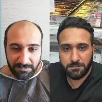 کاشت مو تیم شیراز و مشهد در یزد (تضمینی و اقساطی)