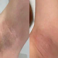 لیزر الکساندرایت. رفع تیرگی بدن. حذف تاتو|خدمات آرایشگری و زیبایی|تربت‌حیدریه, فرمانداری|دیوار