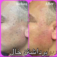 کلینیک لیزر کرایو زگیل خال میخچه حجامت زالو بوتاکس|خدمات آرایشگری و زیبایی|شیراز, حافظیه|دیوار