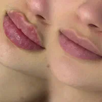 تخفیف جشنواره فیلر ژل لب و صورت یافت اباد فلاح|خدمات آرایشگری و زیبایی|تهران, تولید دارو|دیوار