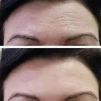 کرم بیوممتیک جای گزین بوتاکس پرداخت درب منزل