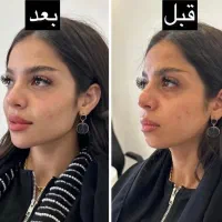 ژل و بوتاکس و پیرسینگ|خدمات آرایشگری و زیبایی|مشهد, خواجه ربیع|دیوار