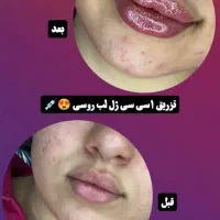 تزریقات ژل شروع قیمت از 750|خدمات آرایشگری و زیبایی|شیراز, شهرک مفتح|دیوار