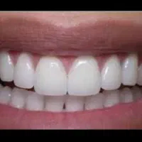 دست  دندان  طرح لمینیت