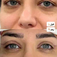 جشنواره پاییزه جراحی زیبایی پلک(بلفاروپلاستی)|خدمات آرایشگری و زیبایی|تهران, قیطریه|دیوار