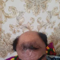 نداشتن مو تو مخته