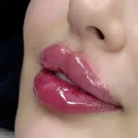 پی آر پی - مزو - ژل - بوتاکس - میکرونیدیلینگ