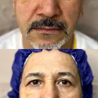 بلفاروپلاستی بوکال فت ساکشن