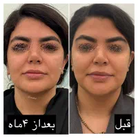 اندولیفت صورت و بدن با دستگاه یوفوتون ایتالیا|خدمات آرایشگری و زیبایی|کرج, شهرک مترو|دیوار