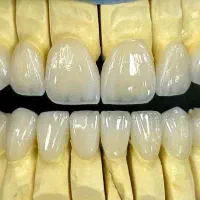 روکش تمام سرامیک ودندان مصنوعی|آرایشی، بهداشتی، درمانی|اندیمشک, |دیوار