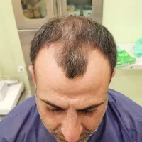 کاشت مو فقط با پرداخت ۱۰ میلیون|خدمات آرایشگری و زیبایی|تهران, جردن|دیوار