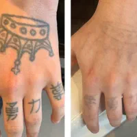 ریموو تاتو صورت و بدن با لیزر کیوسوییچ امریکایی|خدمات آرایشگری و زیبایی|گرگان, |دیوار