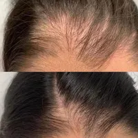 PRP/prpمو/prpصورت/درمان ریزش مو/درمان لک|خدمات آرایشگری و زیبایی|اصفهان, عباس‌آباد|دیوار