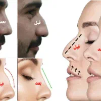 چسب لیفت بینی و شقیقه لوازم ارایشی|آرایشی، بهداشتی، درمانی|چناران, |دیوار