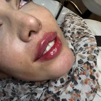 تزریق ژللب ،گونه،زاویه فک و چانه و بوتاکس،مادلینگ|خدمات آرایشگری و زیبایی|اصفهان, رکن الدوله شرقی|دیوار