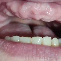 دندان مصنوعی لمینتی طرح لبخند|خدمات آرایشگری و زیبایی|محمدیه-قزوین, |دیوار