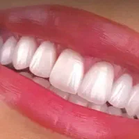 دندانپزشکی/کامپوزیت/ لمینیت/ ایمپلنت/ روکش|خدمات آرایشگری و زیبایی|تهران, هفت حوض|دیوار