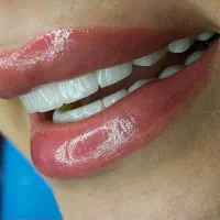 جشنواره کامپوزیت به مدت یک هفته|خدمات زیبایی و سلامت|تهران, شهرک شریعتی|دیوار