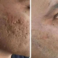 درمان تضمینی و دائم تو رفتگی/جای جوش/اسکار/اگزوزوم