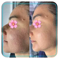 پاکسازی پوست درمان جوش جای جوش لک و کک ومک|خدمات آرایشگری و زیبایی|اصفهان, ملک‌شهر|دیوار