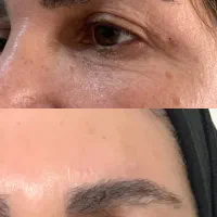 بوتاکس و فیلر صورت برای مدل تحت نظر پزشک|خدمات آرایشگری و زیبایی|زنجان, |دیوار