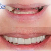 دندانپزشکی و ایمپلنت با روکش رایگان فقط 11/900