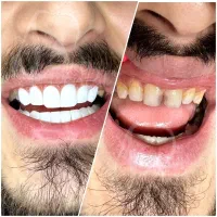 ایمپلنت و زیبایی دندان اقساط ۱۲ ماهه اکو دنتال|خدمات آرایشگری و زیبایی|تهران, خانی آباد نو شمالی|دیوار