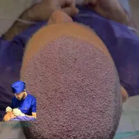 کاشت مو  کاشت ابرو مزوتراپی پی آر پی ژل و بوتاکس