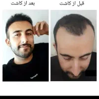 کاشت مو با بالا ترین تراکم و نازلترین قیمت|خدمات آرایشگری و زیبایی|تبریز, |دیوار