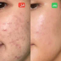 ضد جوش و ضد لک فوری