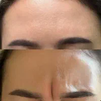 بوتاکس فول فیس فقط 399 هزار