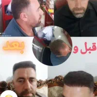 کاشت مو ابروبابروزترین متدروزدنیا|خدمات آرایشگری و زیبایی|خوی, |دیوار