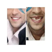 دندانسازی کرمان دندان مصنوعی ژله ای