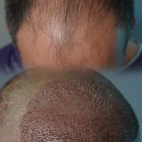 کاشت تخصصی مو به روش FIT|خدمات آرایشگری و زیبایی|رشت, گلسار|دیوار
