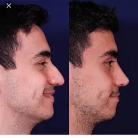 عمل جراحی بینی لیفت خدمات زیبایی با متد پیشرفته|خدمات آرایشگری و زیبایی|کرج, گلشهر|دیوار