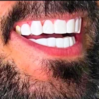 آف ویژه کامپوزیت دندان