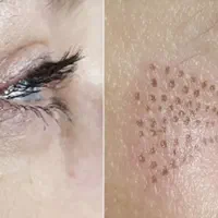 آموزش و کاشت مژه،برداشتن خال،پلاسما جت وپرسینگ|خدمات زیبایی و سلامت|اصفهان, مسجد مصلی|دیوار
