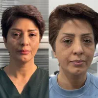نیازمند مدل جراحی افتادگی پلک بالا بلفاروپلاستی