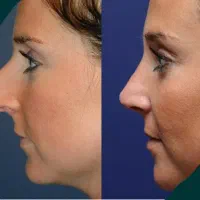 ژنیکوماستی، پیکرتراشی،رینو پلاستی