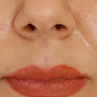 تزریق ژل وبوتاکس