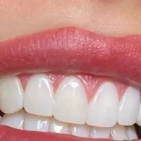 درمان دندان فوری / اقساطی / تخفیف باورنکردنی|خدمات زیبایی و سلامت|تهران, دروس|دیوار