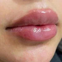 انجام خدمات ژل و بوتاکس|خدمات آرایشگری و زیبایی|اسلامشهر, شهرک مصطفی خمینی|دیوار