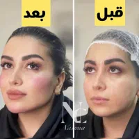 تزریق فیلر بوتاکس،نخ لیفتینگ بانصف قیمت بازار|خدمات آرایشگری و زیبایی|کرمانشاه, |دیوار