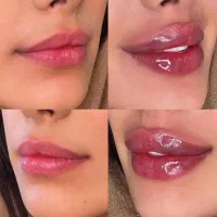 ژل لب فیلر بوتاکس لیفت صورت کانتورینگ آنزیم