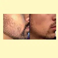 بدون کاشت ریش در بیار