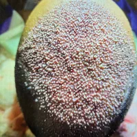 جشنواره کاشت مو