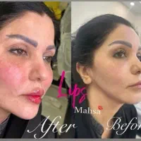 جشنواره پاییزه فیلر لب ژللب بوتاکس زاویه فک گونه|خدمات آرایشگری و زیبایی|کرج, مطهری|دیوار