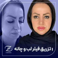بوتاکس مصپورت۹۵۰،لیفت نخ آنزیم بینی فیلر ژل